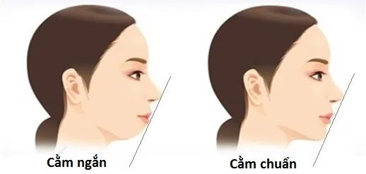 Cằm ngắn là gì?
