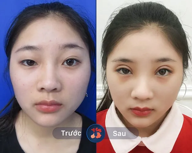 Cơ nâng mi được khôi phục, tạo cân xứng 2 bên mắt.