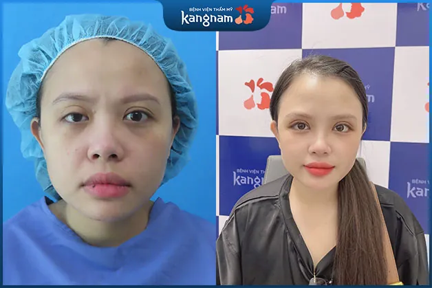 Bấm mí tạo đôi mắt tròn đẹp cân xứng