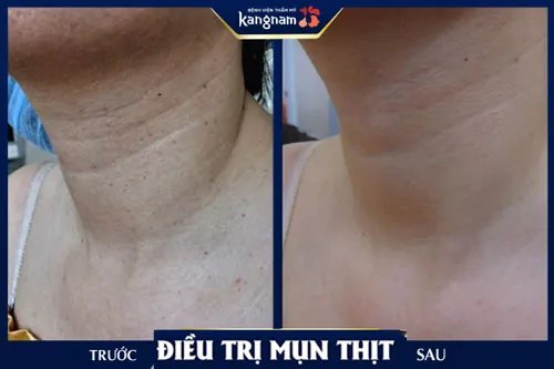  trị mụn thịt ở cổ tại Kangnam