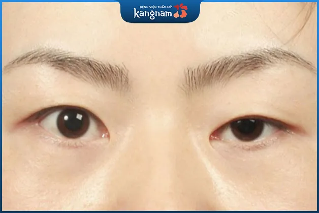 Mắt to nhỏ bẩm sinh