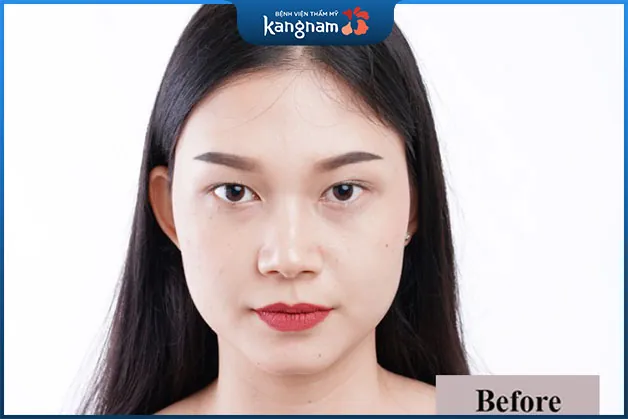 Hình ảnh cho thấy 2 bên mắt không đều nhau.