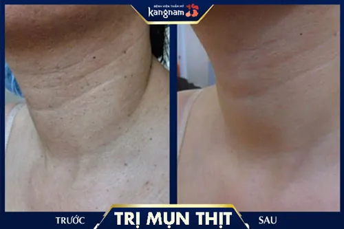 Hình ảnh khách hàg sau khi trị mụn thịt tại Kangnam cách trị mụn thịt