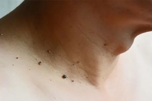 mụn thịt ở cổ có nguy hiểm không