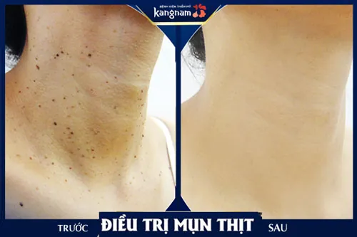 trị mụn thịt ở cổ tại Kangnam