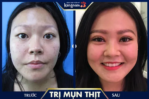 Mụn thịt ở mũi, má được xóa bỏ, da láng mịn không để lại sẹo cách trị mụn thịt ở mũi