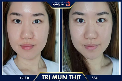 Mụn thịt ở mũi được loại bỏ tối đa, da sáng mịn đều màu hơn trị mụn thịt ở mũi