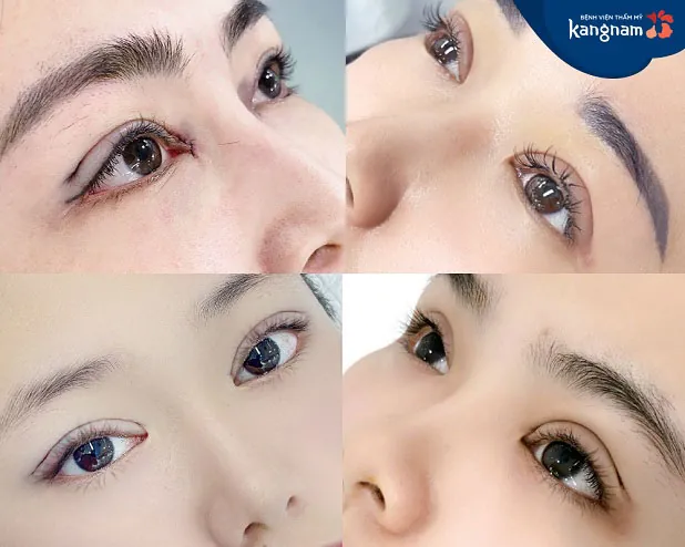 Mí mắt sắc nét đẹp tự nhiên sau khi cắt mí