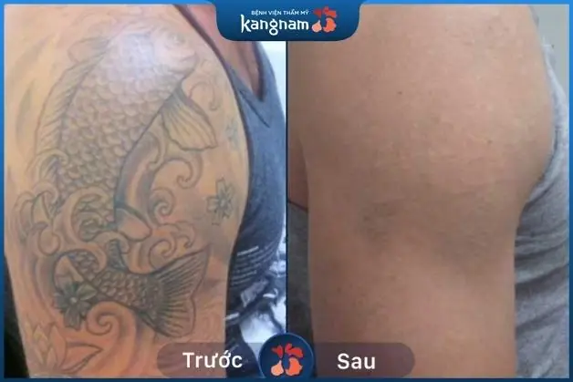 Hình xăm màu đậm bay đáng kể sau 2 lần xóa xăm