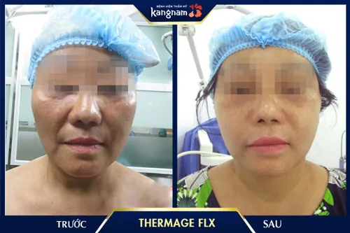 xóa nếp nhăn cánh mũi