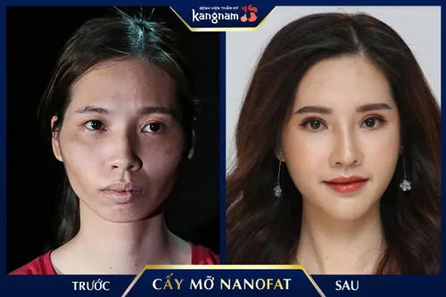 xóa nếp nhăn rãnh mũi