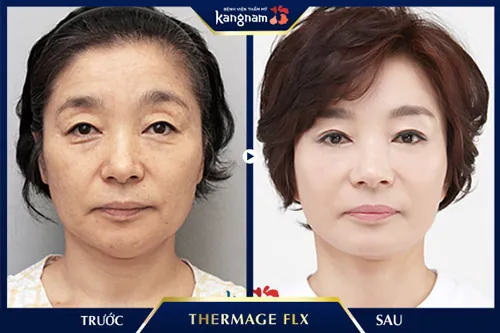 xóa nếp nhăn thermage