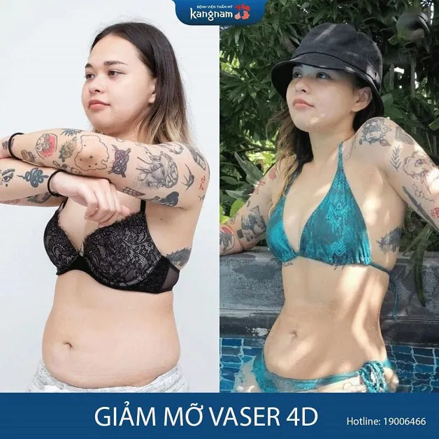 Khách hàng thực hiện giảm mỡ Vaser 4D tại Kangnam