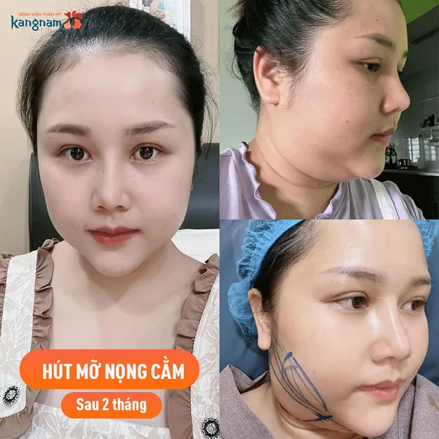 Khách hàng sau 2 tháng hút mỡ nọng cằm