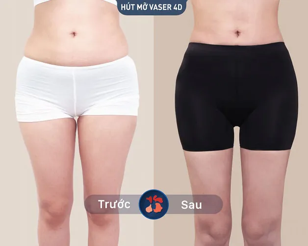 Kết quả sau khi khách hàng hút mỡ thành công tại Kangnam