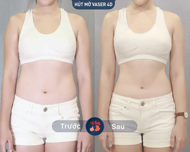 Thân hình trở nên thon gọn và đẹp sau khi khách hàng hút mỡ thành công ở Kangnam