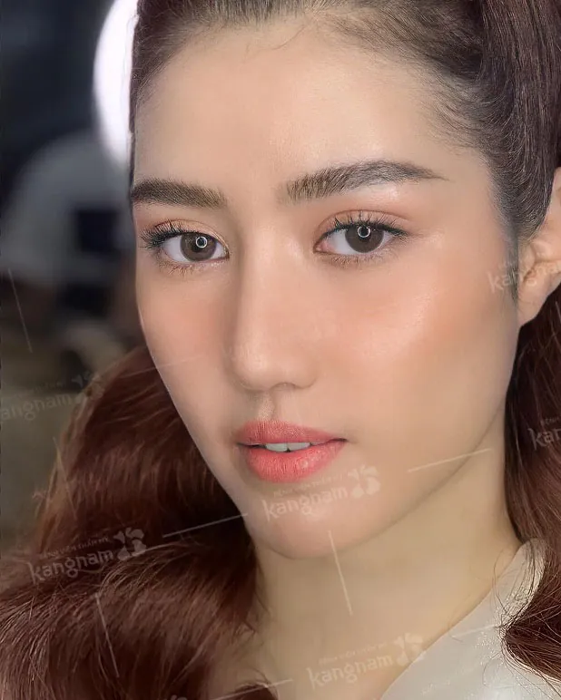 Mắt đẹp không có góc chết ngay sau khi cắt mí