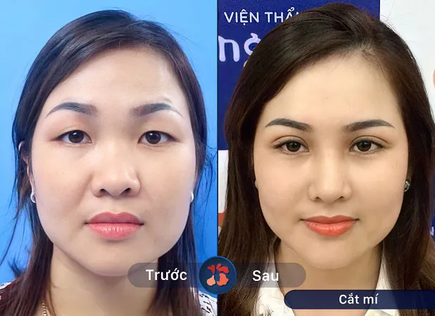 Gương mặt trẻ trung hơn sau khi thực hiện cắt mí