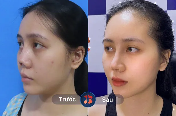 Trước và sau khi khách hàng sửa mũi tại Kangnam