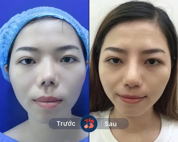 Dáng mũi thay đổi sau khi sửa mũi tại Kangnam