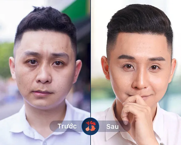 Sau sửa mũi gãy, vẹo vách ngăn: Liêm sở hữu dáng mũi cao thẳng, cải thiện viêm xoang hiệu quả