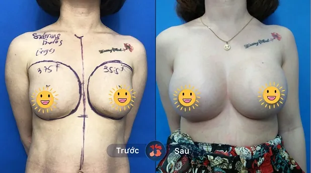 Ngực ổn định sau 1- 2 tháng