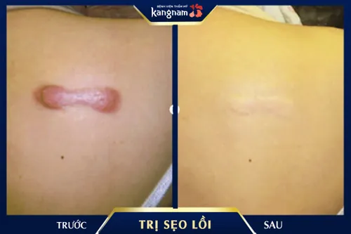 Vùng sẹo lồi sau phẫu thuật đã được cải thiện toàn diện bằng công nghệ ELLA độc quyền tại Kangnam