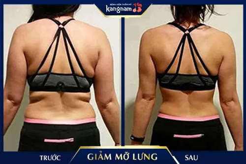 Review cận cảnh kết quả sau giảm mỡ Lipo Matic 3D