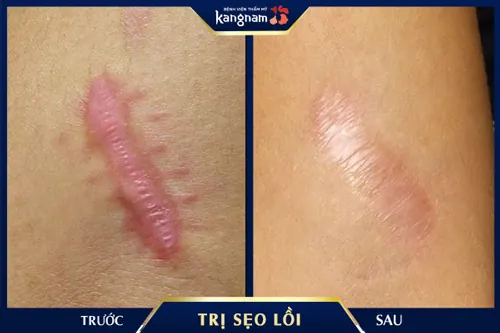 Vết sẹo khâu gần như biến mất hoàn toàn, trả lại làn da mềm mịn đến 90% như ban đầu