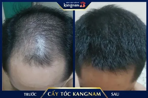 cấy tóc ở đâu tốt 