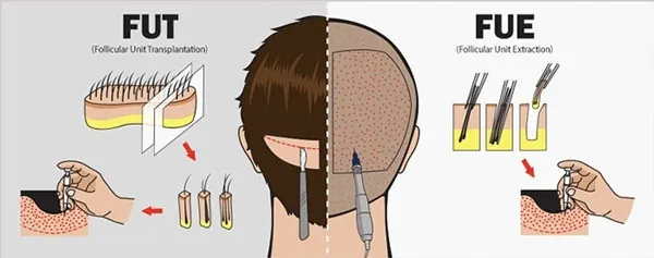 cấy tóc fue ở đâu