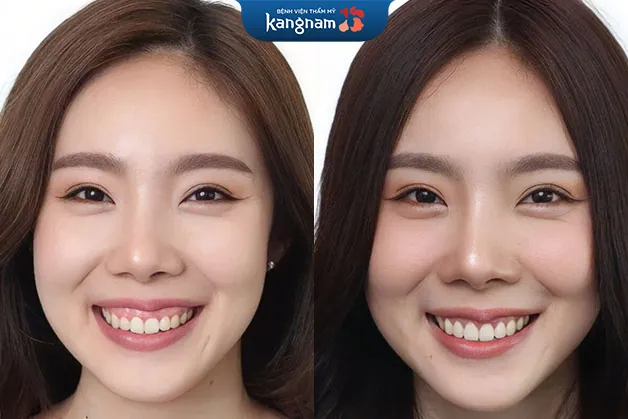 Khắc phục thành công cười hở lợi, đẹp tự nhiên sau 1 lần cải thiện