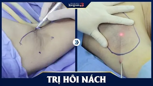 hôi nách nên ăn gì