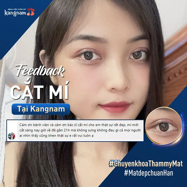 Khách hàng feedback sau khi cắt mí tại bệnh viện Kangnam