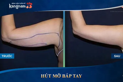 Kết quả khách hàng sau khi giảm mỡ bắp tay tại Kangnam Hồi phục nhanh – Chỉ sau một tuần tay đẹp tự nhiên không bắp mỡ