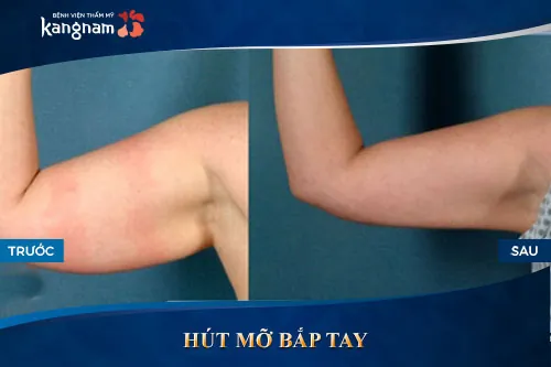 Giảm mỡ bắp tay tại Kangnam Vùng da hút mỡ căng mịn không lộ dấu tích thẩm mỹ