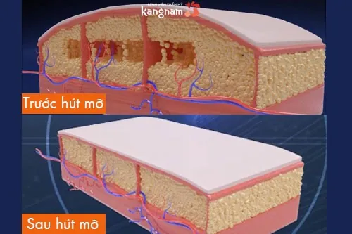 Da săn chắc, phẳng mịn tự nhiên sau khi hút mỡ Vùng da sau hút mỡ được săn chắc hơn trông thấy.