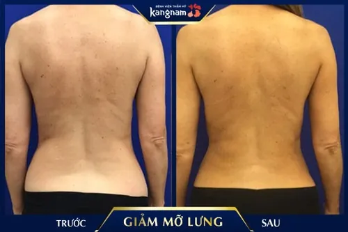 Khách hàng giảm mỡ lưng thành công tại Kangnam