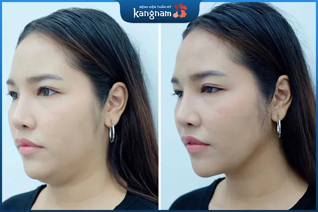 Nọng cằm biến mặt sau khi giảm mỡ mặt tại Kangnam