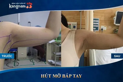 Kết quả khách hàng sau khi giảm mỡ bắp tay tại Kangnam Sau khoảng 30 – 45 phút thực hiện, mỡ tay đã biến mất, trả lại đôi tay thon gọn