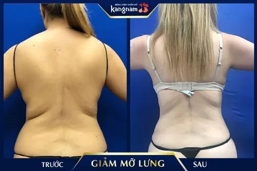 Kết quả giảm mỡ lưng không phẫu thuật của khách hàng tại Kangnam.