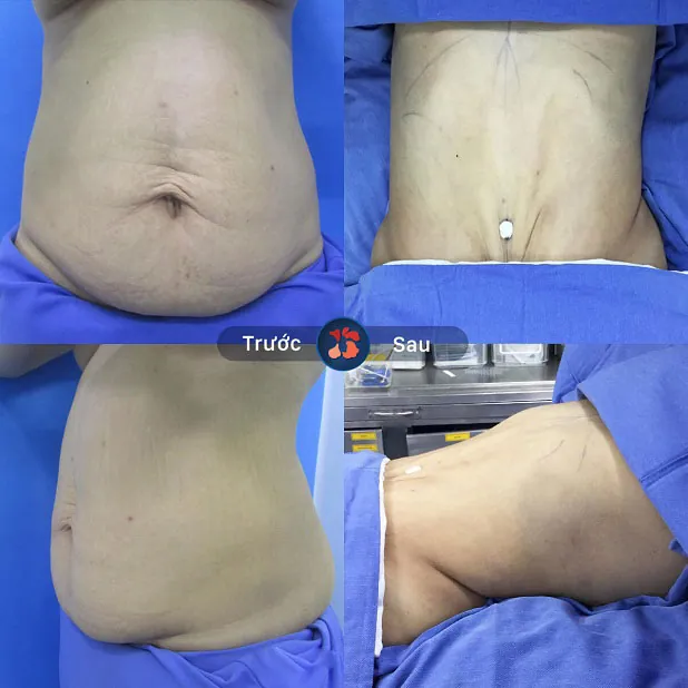 Hút mỡ bằng công nghệ hiện đại tại Kangnam