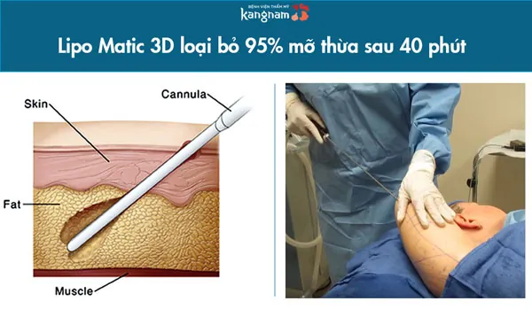 giảm béo cánh tay và vai cấp tốc tại Kangnam Giảm béo cánh tay và vai cấp tốc