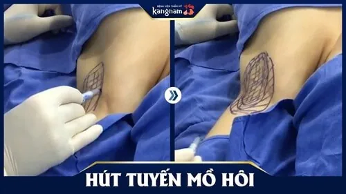 hút tuyền mồ hôi nách kangnam