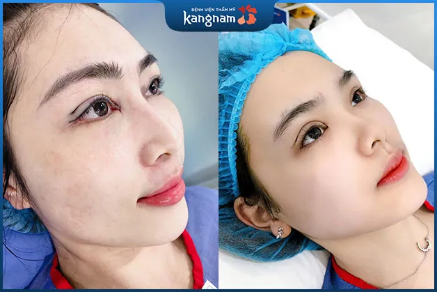 Mí đẹp ngay khi kết thúc thủ thuật