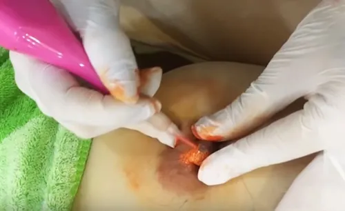 Phun xăm nhũ không phải là giải pháp an toàn và hiệu quả nhất làm hồng nhũ hoa ở đâu tốt