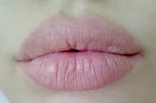 Môi thiếu dưỡng chất gây tình trạng khô ráp