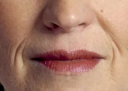 Môi thiếu độ ẩm và xuất hiện nếp nhăn