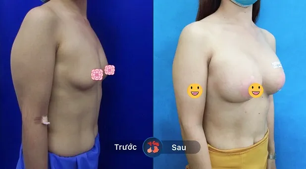 Vòng 1 thay đổi sau khi nâng ngực tại Kangnam