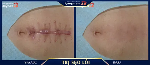 Sẹo lớn đã biến mất hoàn toàn sau khi áp dụng phương pháp phẫu thuật cắt sẹo thẩm mỹ